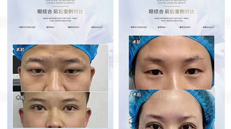 广州割双眼皮公立医院与私立医院区别