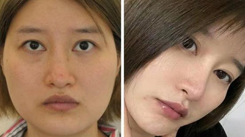 轻医美项目最佳年龄