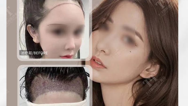 埋线提升后，这些护理禁忌才是恢复关键