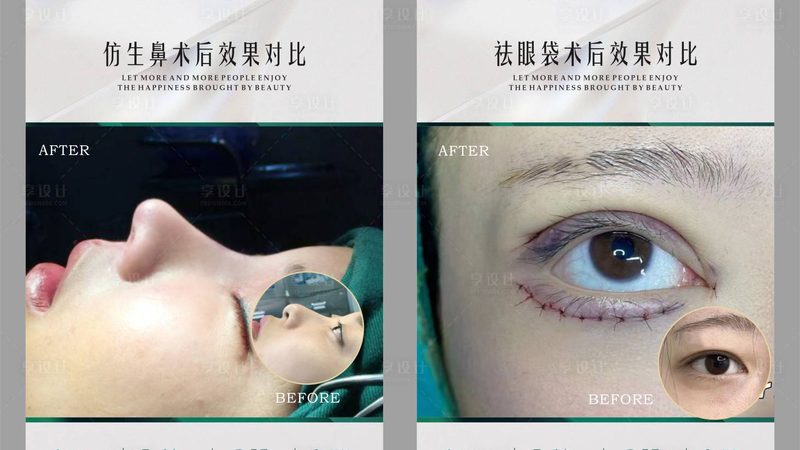 北京埋线提升步骤揭秘：美丽无痕，青春再现