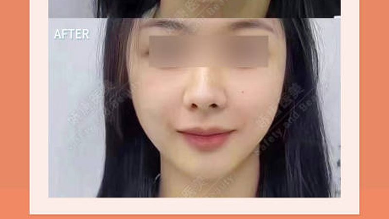 上海埋线提升，如何选择合适的材料品牌？**