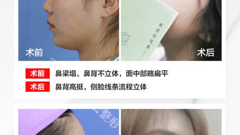 医美咨询师案例分享：揭秘整形咨询背后的专业技巧