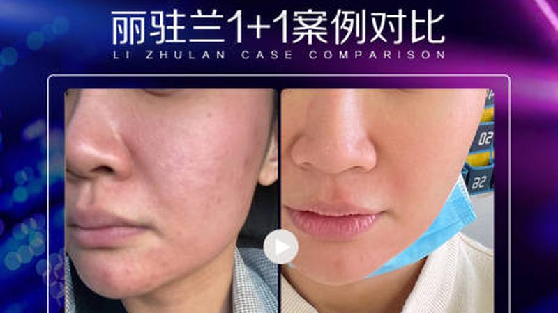 下颌角瘦脸，揭秘价格背后的真相