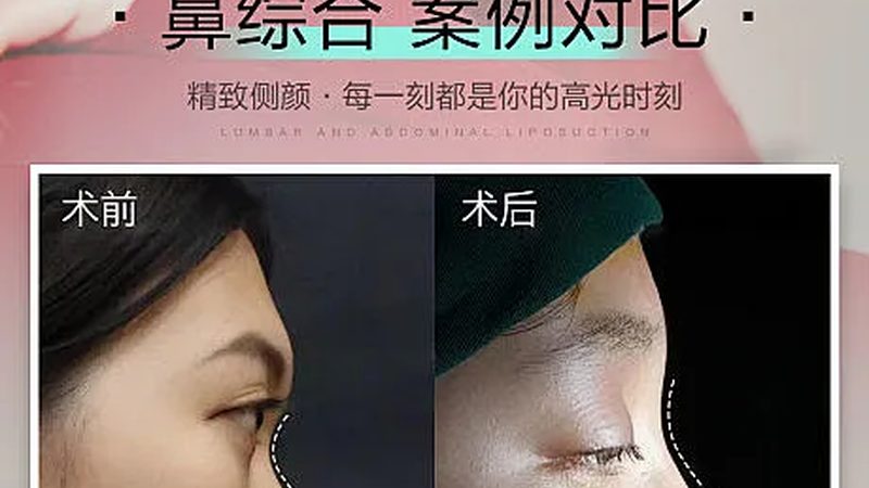 光子嫩肤祛痘印，术后护理攻略揭秘