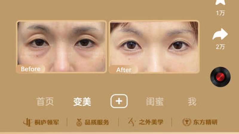 双眼皮修复失败？揭秘厦门二次修复的价格与关键因素